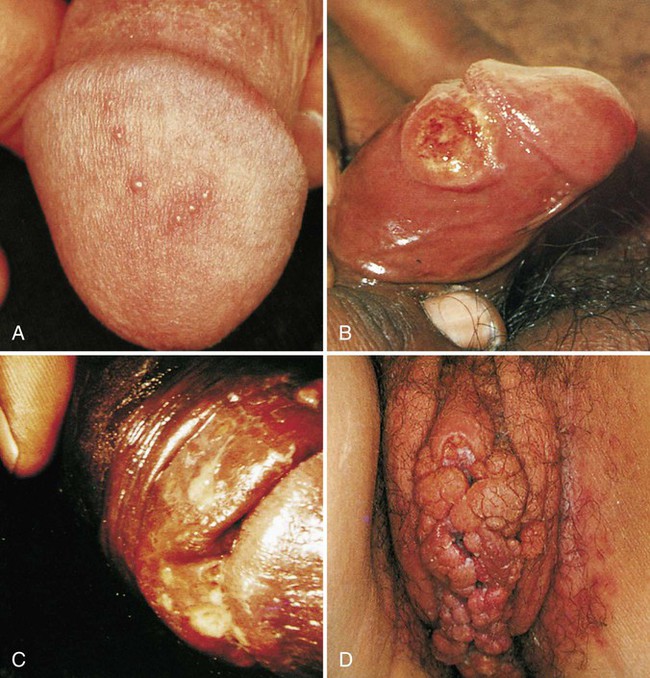 Male Genital Herpes