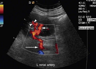 What is renal artery ultrasound?