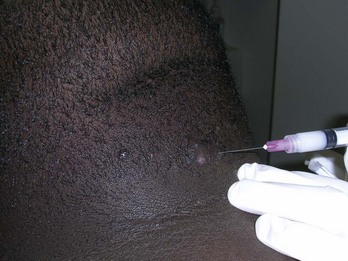 Intralesional steroid injections for alopecia