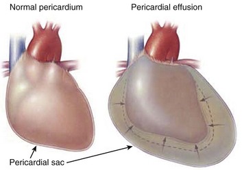 Image result for tamponade cardiac