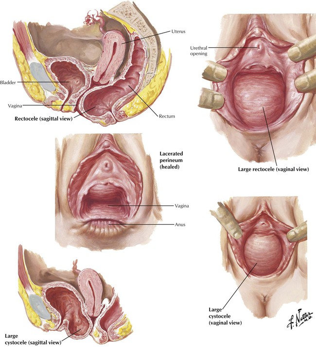 What are the treatments for atrophy of the vulva & vagina ...