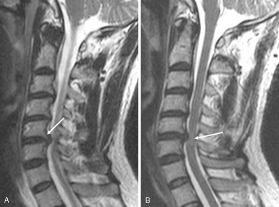 What is retrolisthesis of c5 on c6