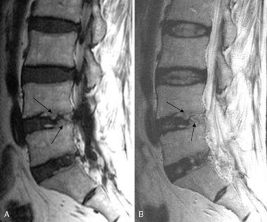 L5 retrolisthesis