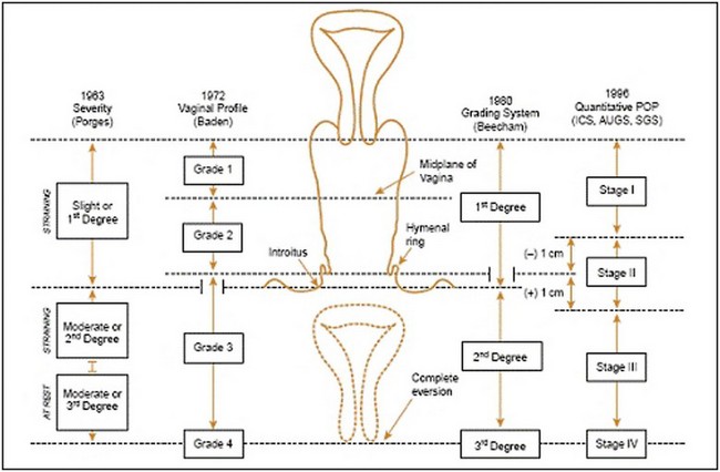 Pelvic Organ Prolapse Clinical Gate