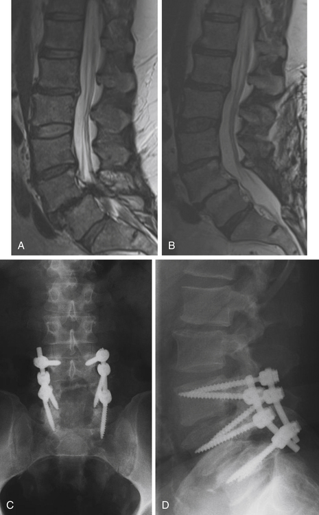 What exercises are safe for someone with spinal stenosis (L2, L3) spondylolisthesis and osteopenia?