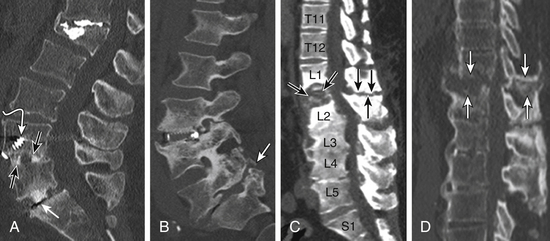 L5 retrolisthesis