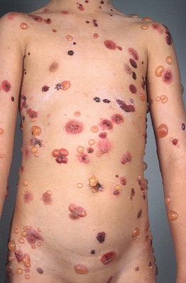 SciELO - Brasil - Multiple pilomatricomas in twins with Rubinstein