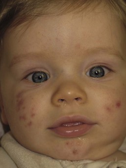 11 Common-to-Rare Infant Skin Conditions - Medscape