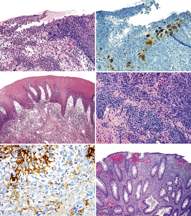 Anal Canal Inflammation 34