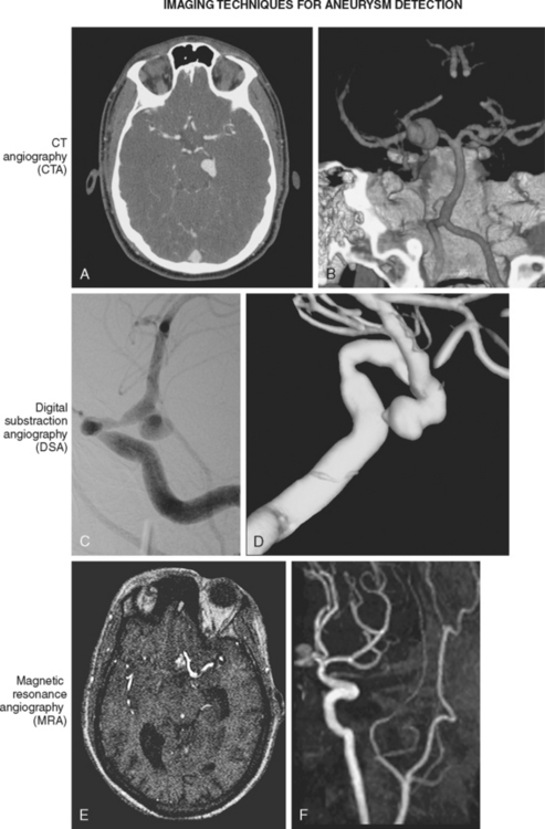 Subarachnoid Hemorrhage Clinical Gate