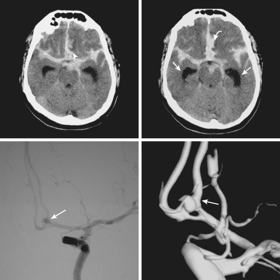 Subarachnoid Hemorrhage Clinical Gate