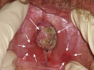 Lip Cancer / Skin Cancer Picture from UI Dermatology ...