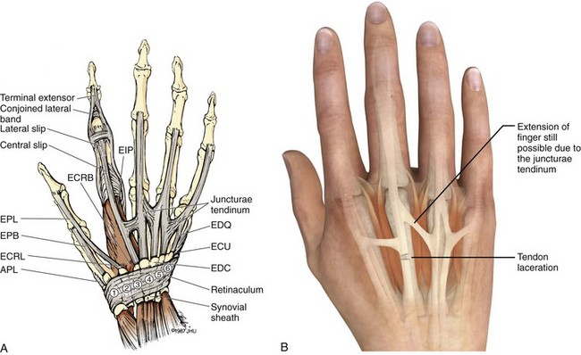 Extensor and Flexor Tendon Injuries in the Hand, Wrist, and Foot