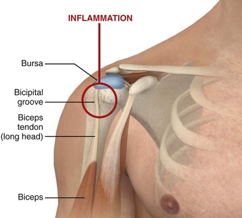 Steroid injection area