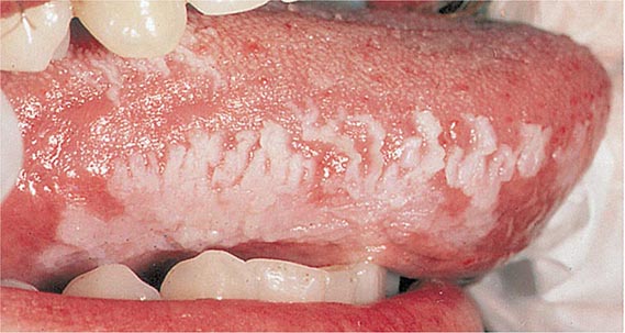 What complications are possible with an Epstein-Barr infection?