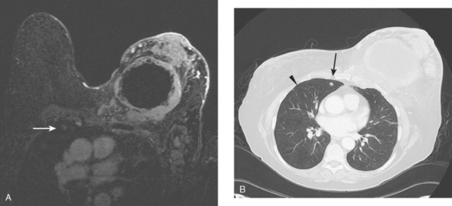 What is breast cancer with chest wall involvement?