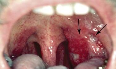 Oral herpes t