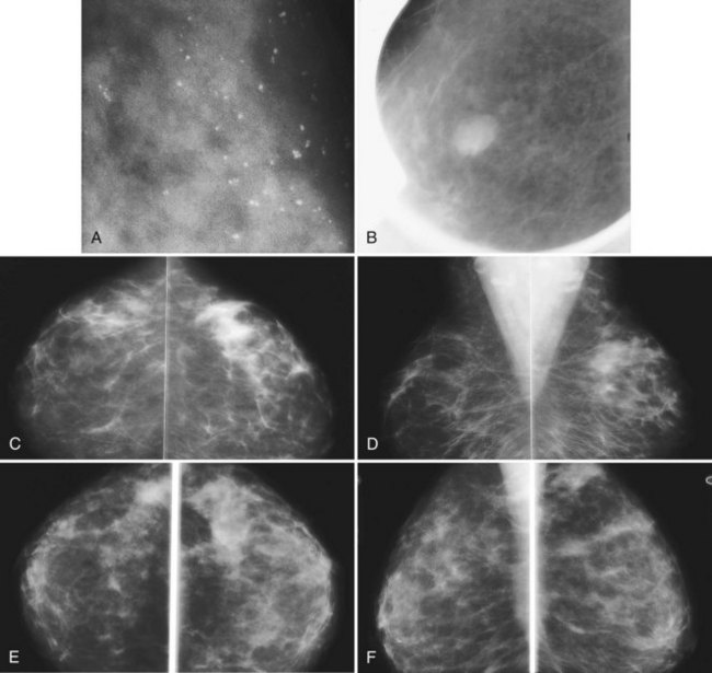 Probably Benign Breast Tissue 7