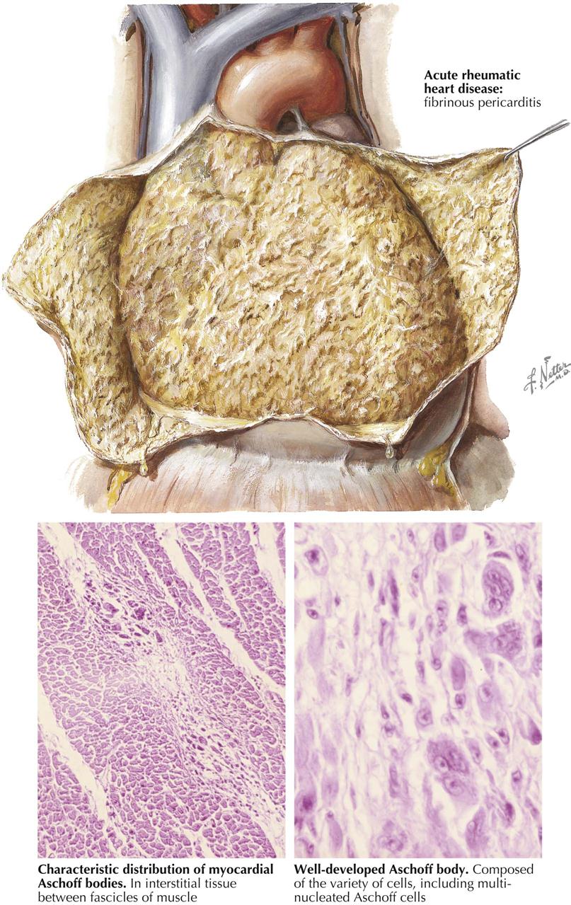 Rheumatic heart disease thesis