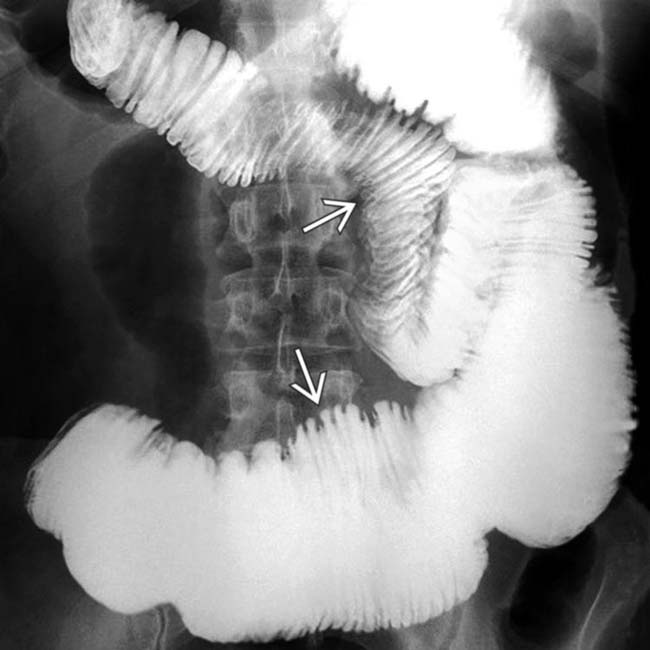 Image result for scleroderma gut