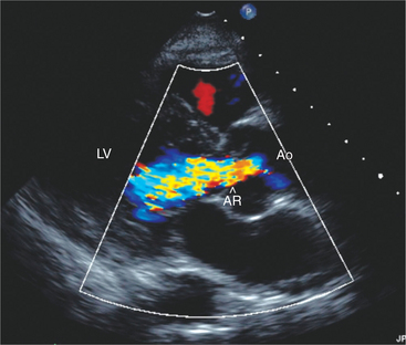 Aortic Valve Echo Parasternal Long Axis