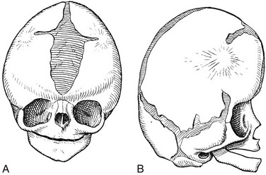apert syndrome skull