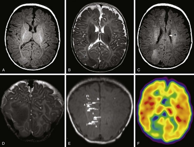 Neuroimaging In Pediatric Epilepsy Clinical Gate