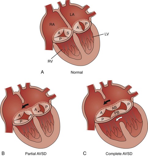 septal-defects-clinical-gate