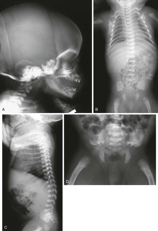 achondroplasia x ray baby