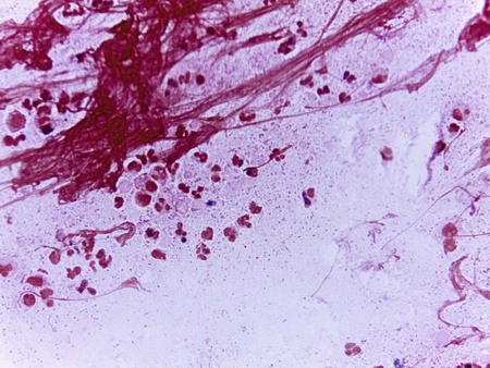 haemophilus influenzae slide