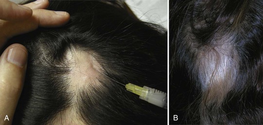 Steroid Injections in Alopecia Areata: Advice for the Primary Care  Practitioner and Other Physicians who Treat Alopecia — Donovan Hair Clinic