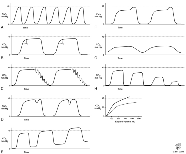 Carbon Dioxide Retention And Capnography | Clinical Gate