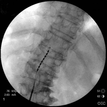 migration of dorsal column spinal cord stimulator