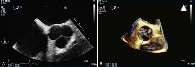 Evaluation Of The Aortic Valve Clinical Gate