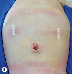 pyloric stenosis scar