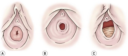 Prepubertal Vagina