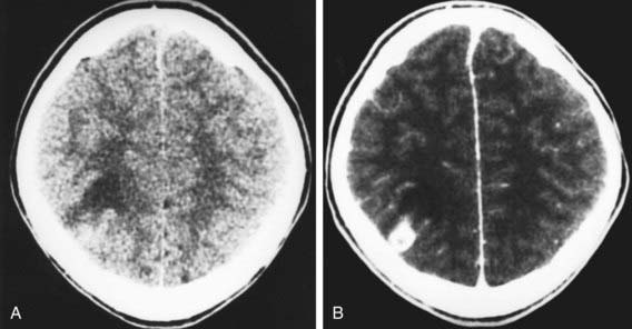 Cysticercosis | Clinical Gate