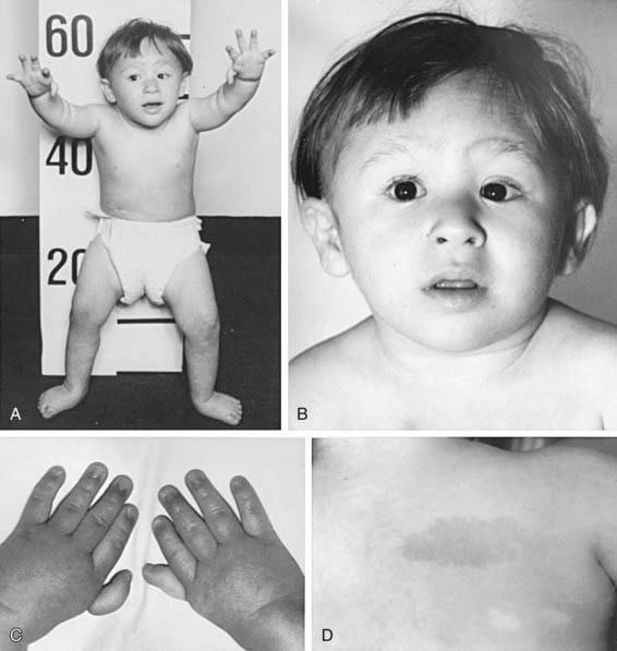 The Inherited Pancytopenias | Clinical Gate