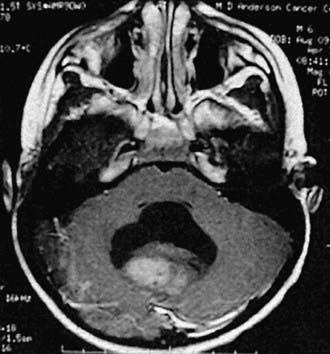 Brain Tumors In Childhood | Clinical Gate