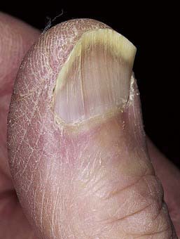 Disorders of the Nails | Clinical Gate