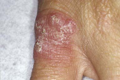 Cutaneous Bacterial Infections | Clinical Gate