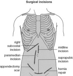 left subcostal incision