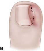 Disorders of Nails and Skin | Clinical Gate