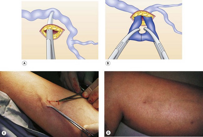 Varicose Veins and Their Treatment by Trendelenburg's Operation