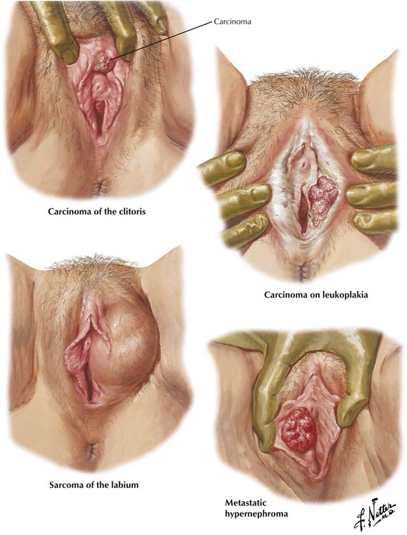 Squamous cell carcinoma of the vulva