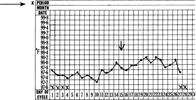 Ectopic Pregnancy Bbt Chart