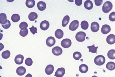 Macrocytic Anemia | Clinical Gate