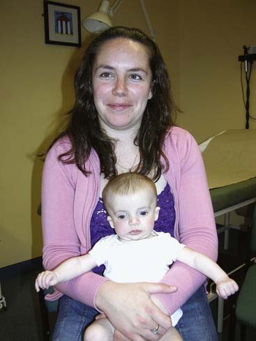 Синдром тричера коллинза фото сестры аделины сотниковой