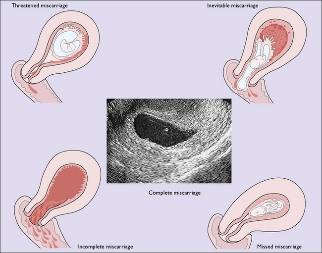 Varieties of spontaneous miscarriage.