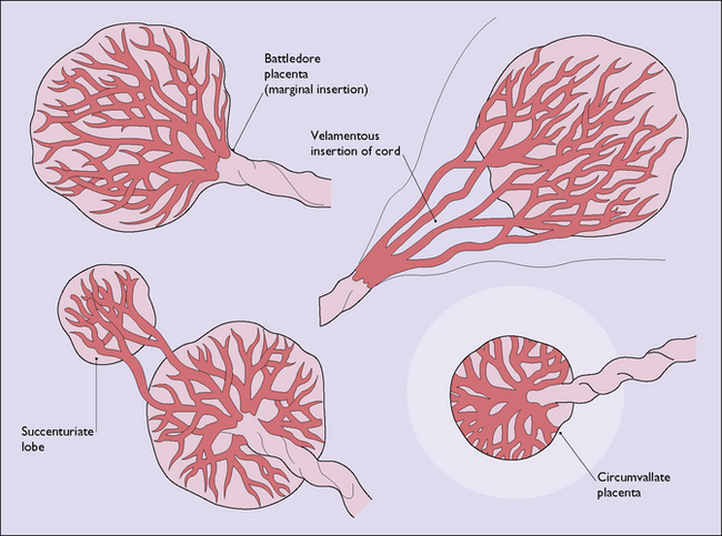 diseases-of-the-placenta-and-membranes-clinical-gate